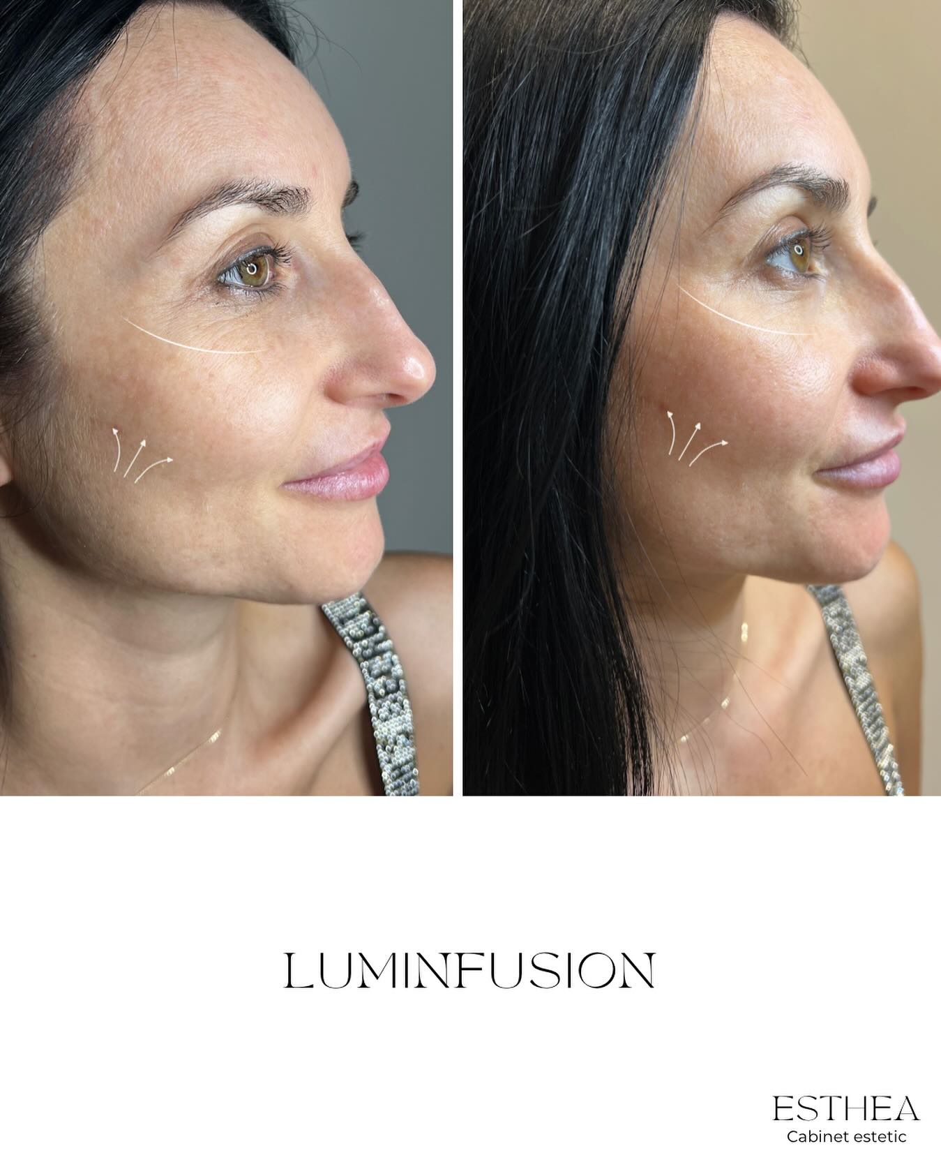 Rezultat înainte și după LuminFusion la ESTHEA